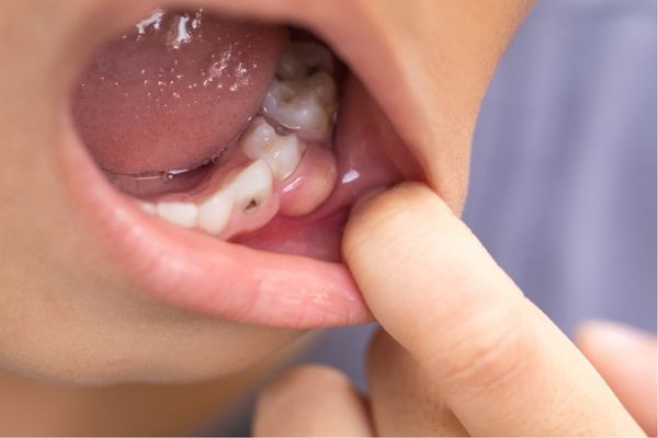 a child has a cavity on a front bottom tooth