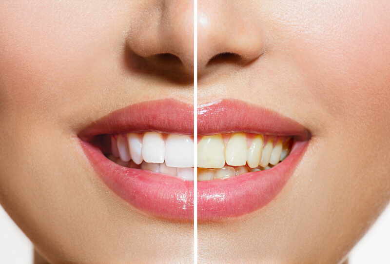 woman smiles with before and after of her teeth withcosmetic dental services