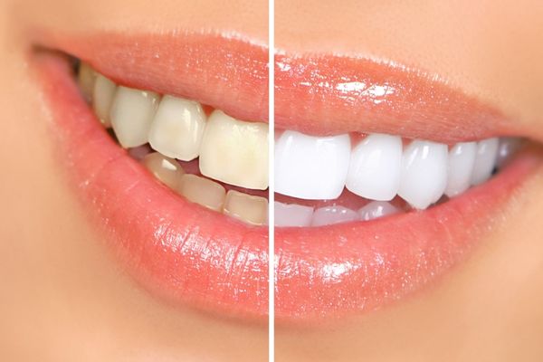 before and after image of a woman's smile