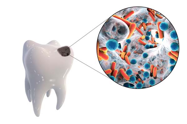 Tooth with dental caries and close-up view of microbes which cause caries, 3D illustration
